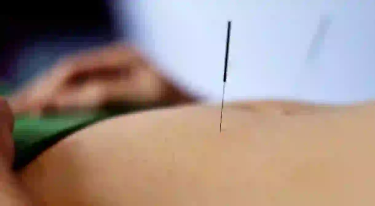 Acupuncture